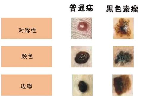 痣 顏色|痣是什麼？會變成黑色素瘤？7種一定要除的痣